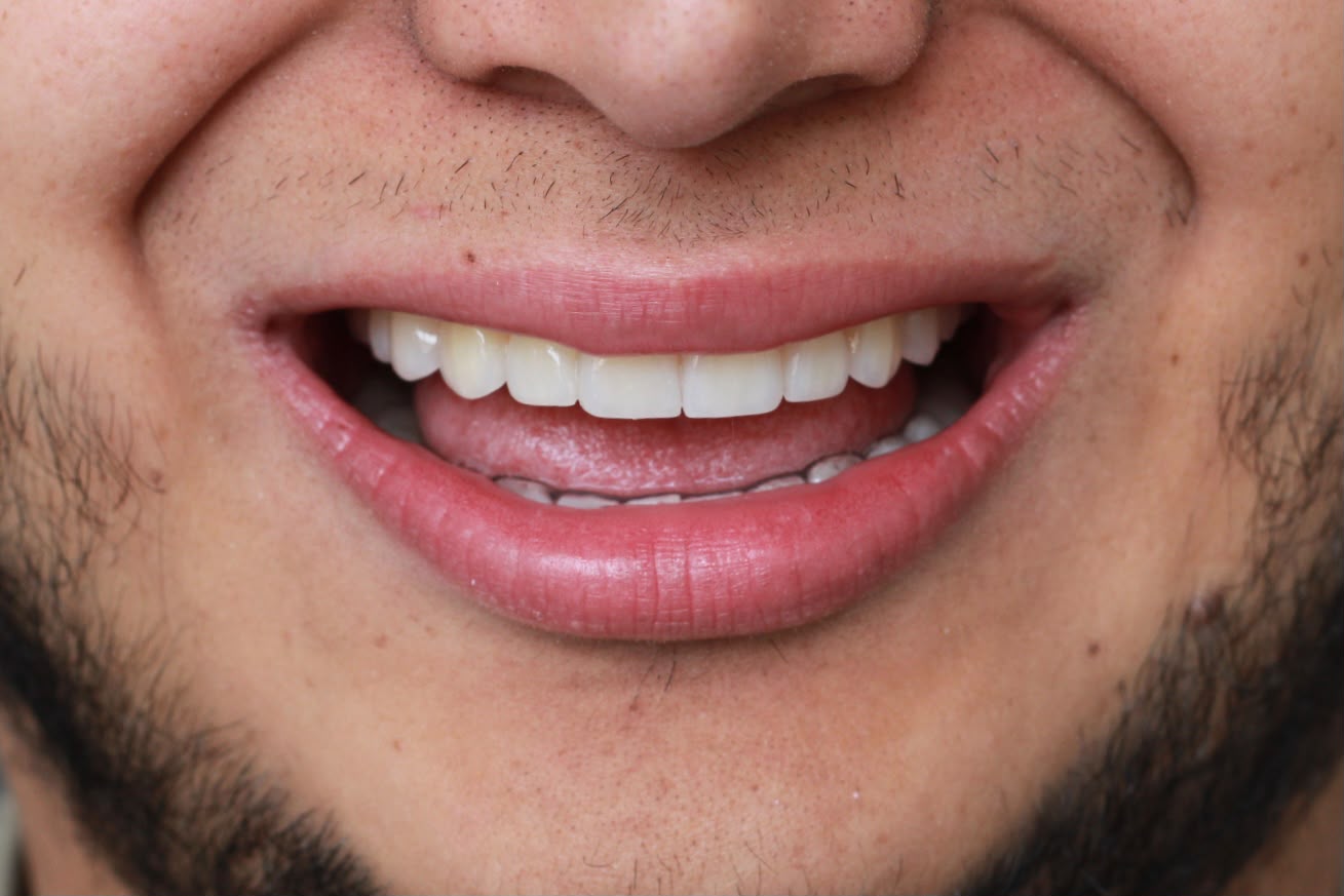 La misma sonrisa después del tratamiento, con los dientes parejos y aclarados