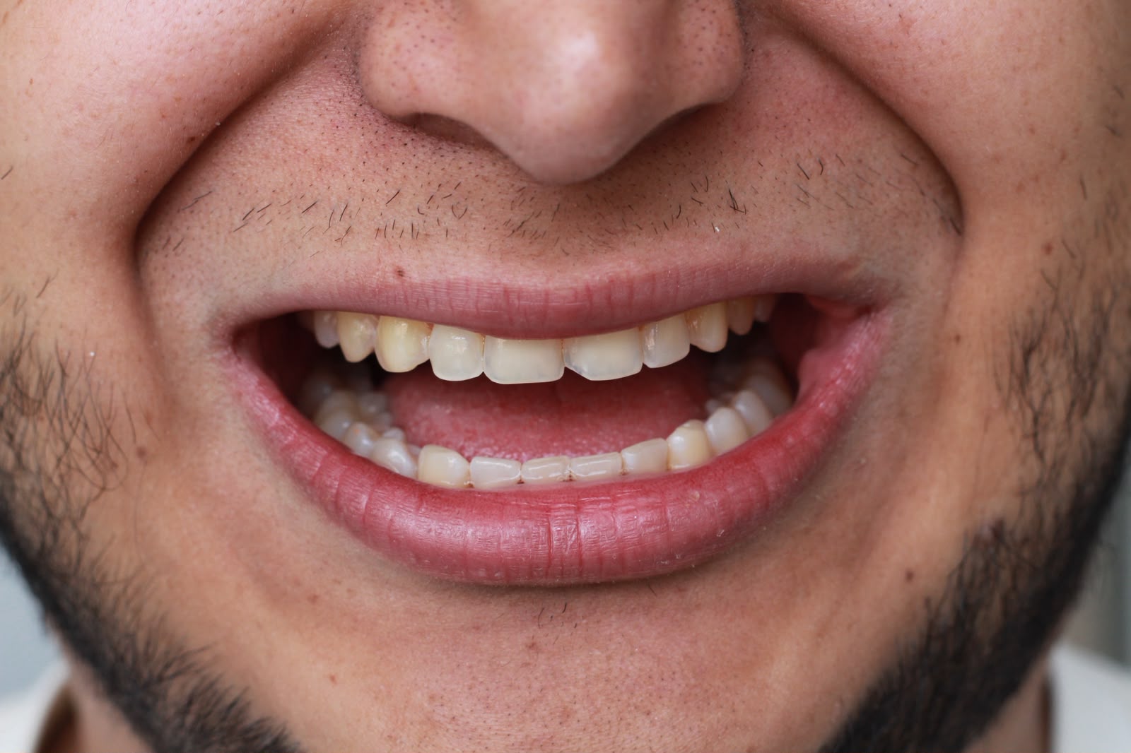Sonrisa de un paciente antes del tratamiento de estética dental