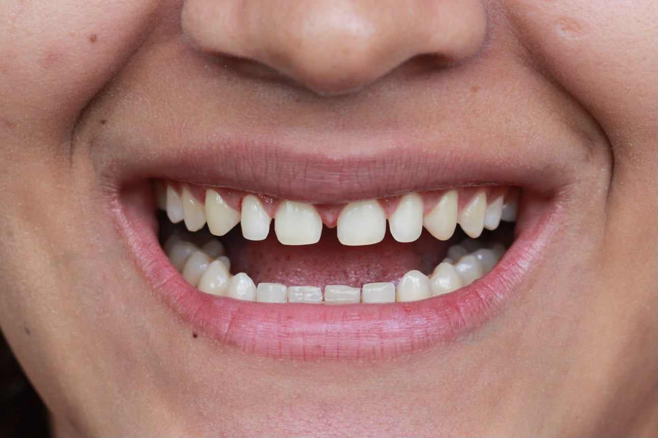 Sonrisa antes del tratamiento, con separación entre los dientes de adelante