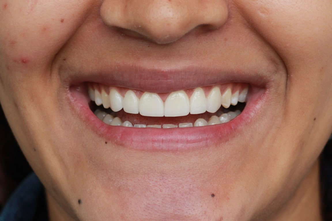 La misma sonrisa después de cerrar la separación entre los dientes