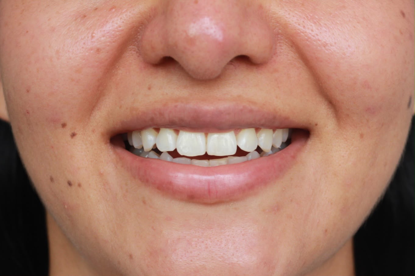 Sonrisa antes del tratamiento, con restauraciones antiguas y dientes amarillentos