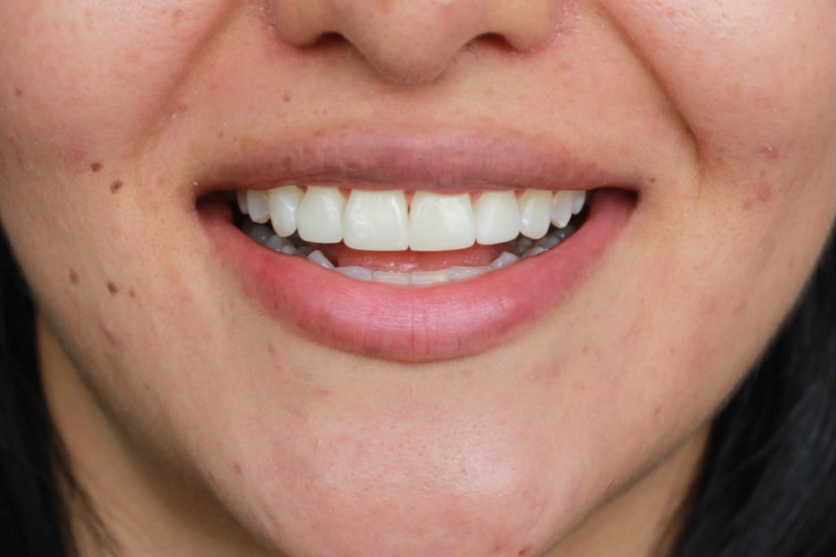 La misma sonrisa después del tratamiento de estética dental