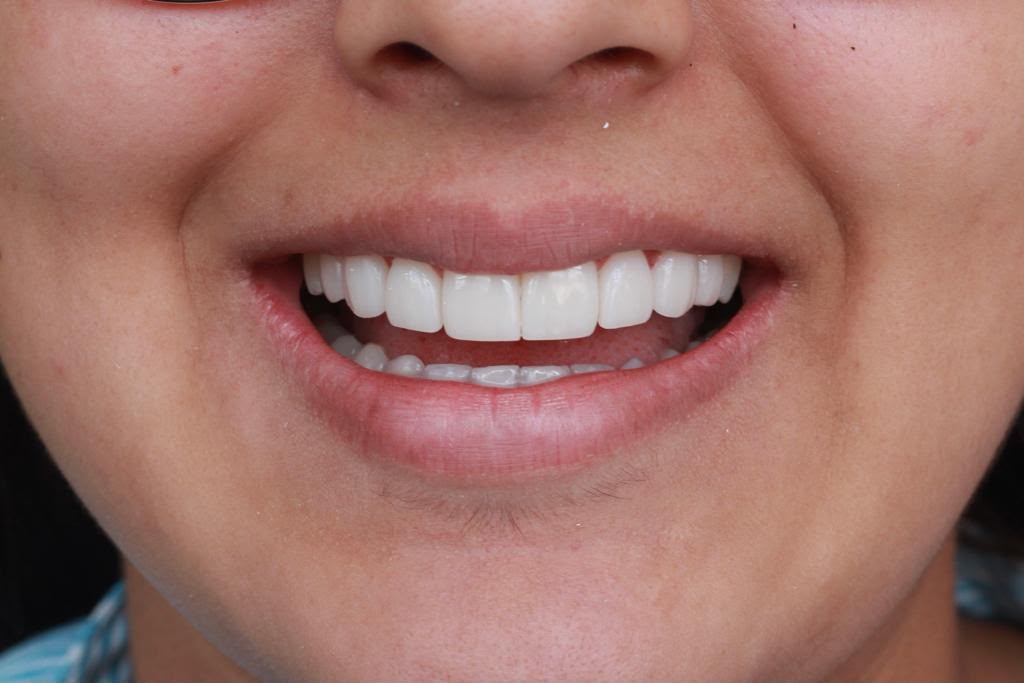 La misma sonrisa después del tratamiento, con los dientes alineados y aclarados