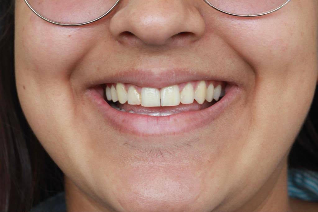 Sonrisa antes del tratamiento, con los dientes desalineados y oscurecidos